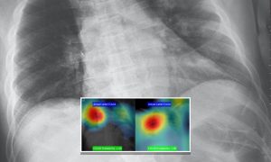 Coronavírus: Software desenvolvido por Inteligência Artificial pode detectar Covid-19 nos raios X do tórax em questão de segundos e com 98% de precisão; por Stacy Liberatore e Natalie Rahhal/Dailymail