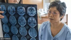Casos de demência devem quase triplicar até 2050, diz estudo; BBC