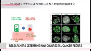 Pesquisadores identificam causa de reincidência do câncer colorretal; NHK